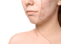 Managing Acne