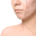 Managing Acne
