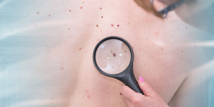 Magnifying Melanoma