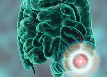 New relationship found between bacteria and bowel cancer