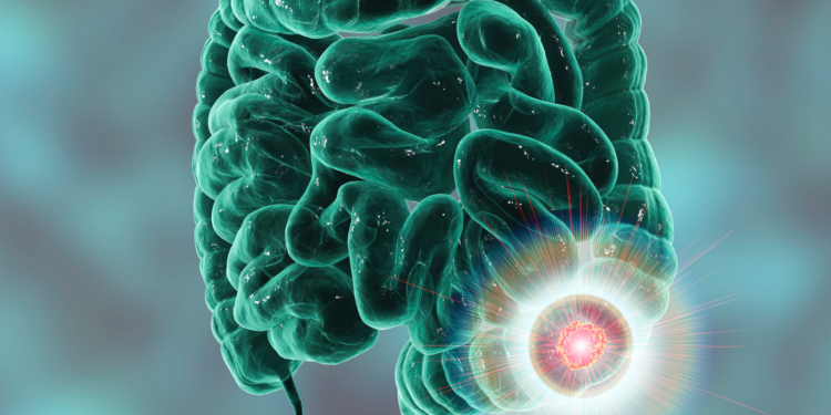 New relationship found between bacteria and bowel cancer