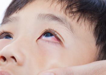 Conjunctivitis in Children: The Pharmacy Role