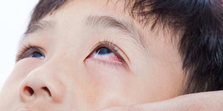 Conjunctivitis in Children: The Pharmacy Role