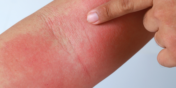 JAMA Dermatology Publishes Data Showing upadacitinib Achieved Superiority Versus dupilumab for Primary and All Ranked Secondary Endpoints in Phase 3b Head-to-Head Study in Adults with Atopic Dermatitis