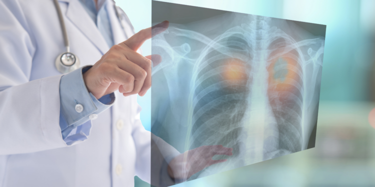 The Role of the Pharmacist in Referring Clients with Lung Cancer ‘Alarm’ Signs and Symptoms