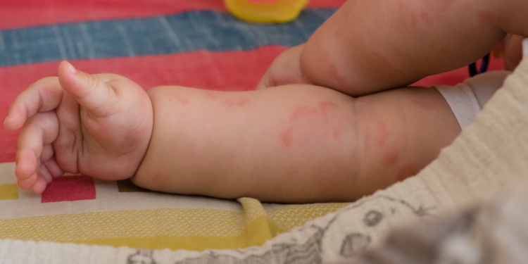 Common skin problems in babies – management and myths