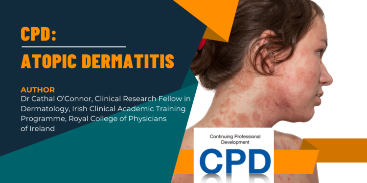 CPD: Management of Atopic Dermatitis