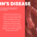 Overview and Risk Factors for Crohn’s Disease