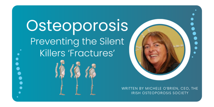 Osteoporosis – Preventing the Silent Killers “Fractures”