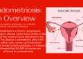 Endometriosis: An Overview
