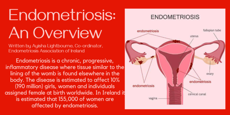 Endometriosis: An Overview